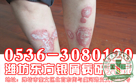 夏季银屑病护理方法有哪些?