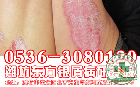 寻常型银屑病的发病症状你真的了解吗？
