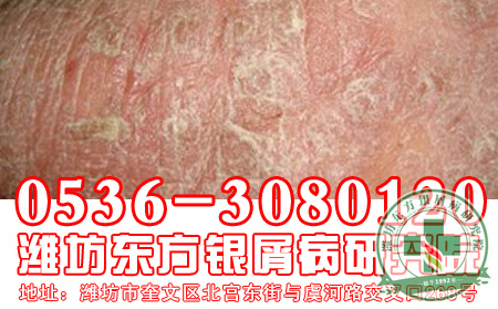 脓疱型银屑病在治疗的时候应该注意做可以哪些护