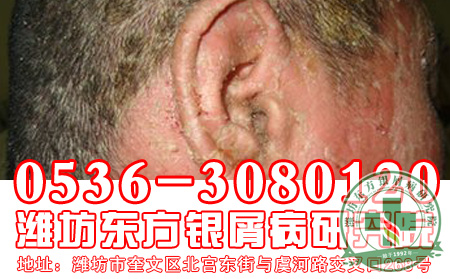 红皮型银屑病的严重发病症状是怎样的?