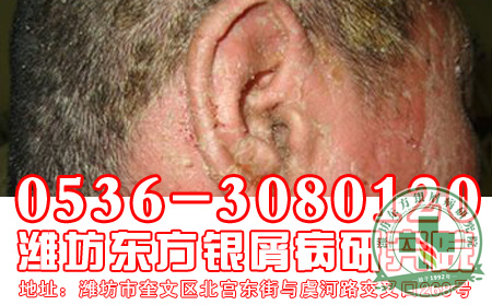 红皮型牛皮癣的治疗工作患者怎样做 可以?
