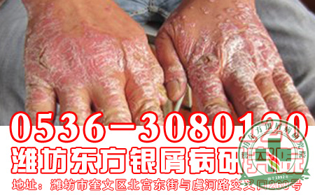 关节型牛皮癣的危害有哪一些?