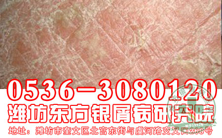 脓疱型银屑病这种严重银屑病发病的原因是什么