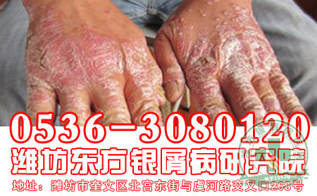 患者对于关节型银屑病的发病应该注意到什么？