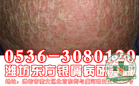 对于银屑病的危害和治疗患者应该知道什么?