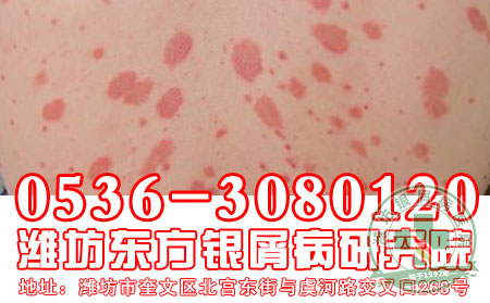 寻常型银屑病在选择治疗应该注意什么？