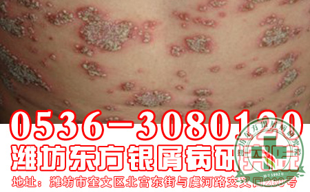 患者对于脓疱型银屑病的发病危害应该注意什么