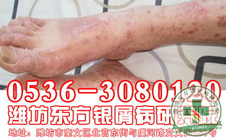 寻常型银屑病的护理工作患者应该怎样做?
