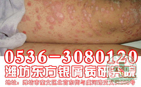 医生畅谈:按摩对银屑病的三大可以处