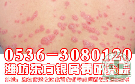 潍坊牛皮癣医院关节型牛皮癣治疗措施有哪些?