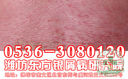 银屑病预防新策略,你了解吗?