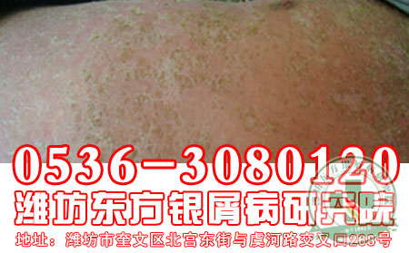 牛皮癣冬季饮食有啥禁忌?