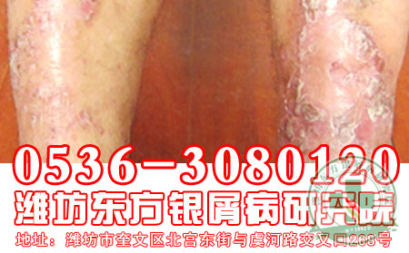 儿童得了银屑病怎么诊断呢?