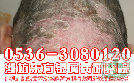 如何缓解银屑病瘙痒?我们有一套！