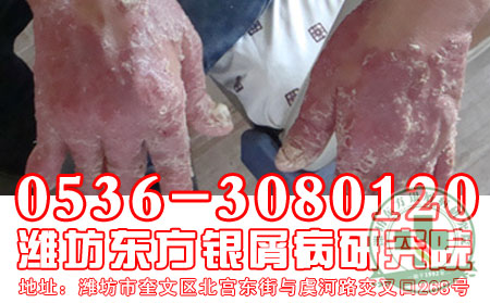 脓疱型银屑病生活中该留意什么?