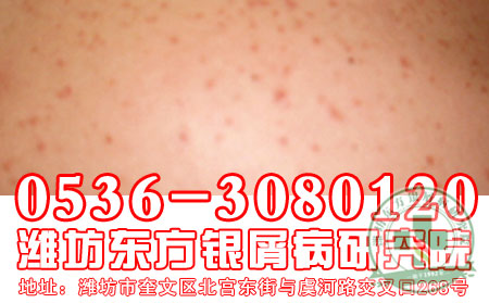 医生简述：关节型银屑病护理问题