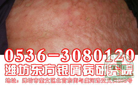 银屑病患者能吃高纤维食物吗?