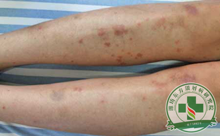 牛皮癣治疗