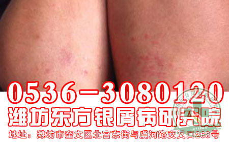 患者关注！牛皮癣疾病多长时间能治可以？