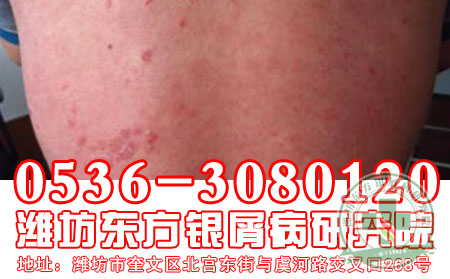 牛皮癣治疗选择什么时候效果 可以？