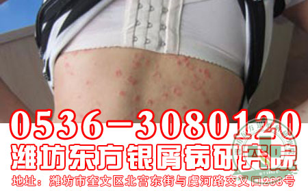 患者分享：牛皮癣治疗心得