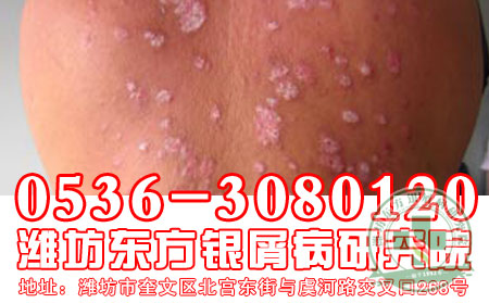 医生讲解关于牛皮癣治疗常识问题