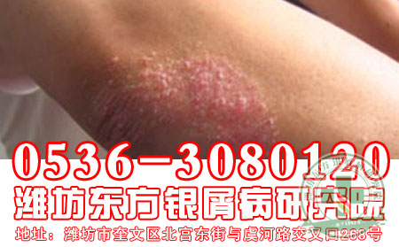 患者介绍牛皮癣护理 可以的方法