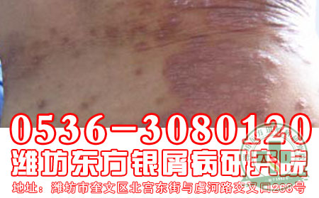 冬季牛皮癣 可以疗法