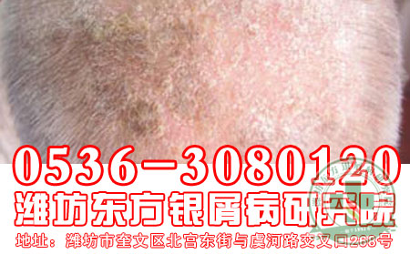 潍坊比较可以牛皮癣皮肤病医院地址