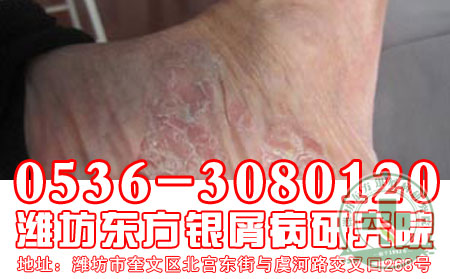  可以的牛皮癣专科医院路线【 新银肖病】