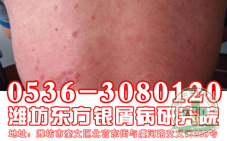 潍坊牛皮癣医院【走进潍坊】【体验 】