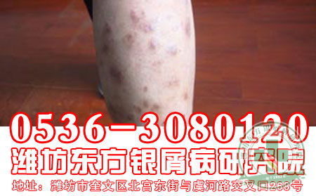 哪个牛皮癣皮肤病医院较可以【强烈关注】