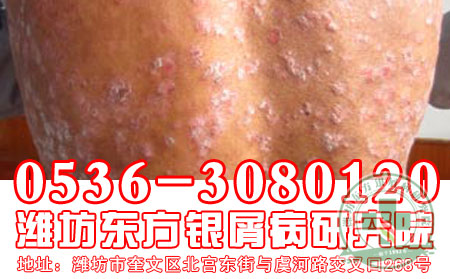 潍坊牛皮癣医院在哪里【2013牛皮癣治疗】【 新