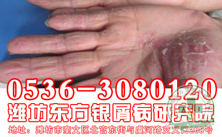 男性牛皮癣治疗 可以的医院