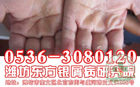 牛皮癣如何治疗才能减少复发？