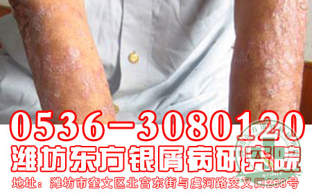 潍坊牛皮癣医院医生教你如何缓解牛皮癣瘙痒？