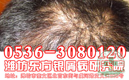 潍坊牛皮癣医院医生浅谈牛皮癣预防问题