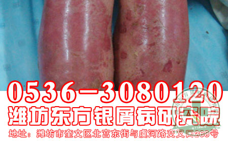 红皮病型牛皮癣的危害有哪些