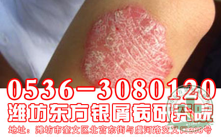 脸部银屑病治疗用药须知！