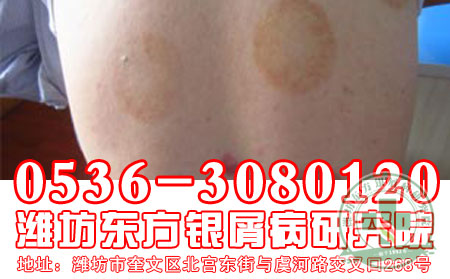 牛皮癣患者治疗期间应该如何护理？