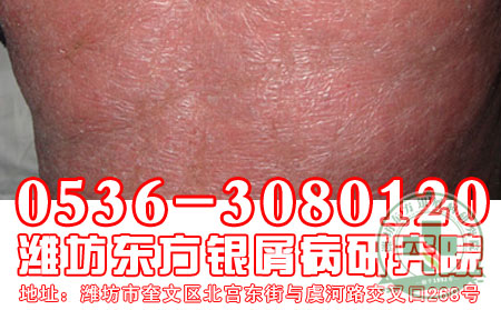 警惕牛皮癣并发症