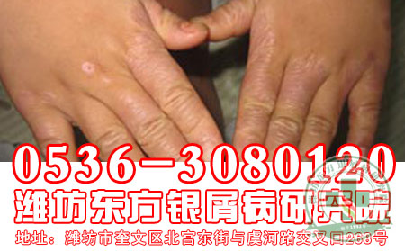 烟民朋友注意了！当心牛皮癣找上你