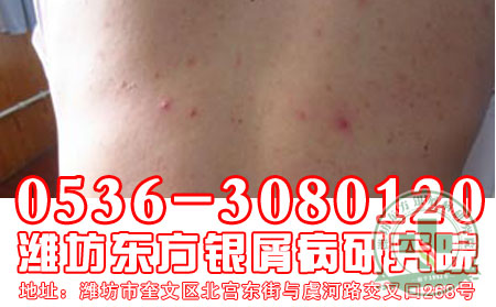 牛皮癣发病与性格有关