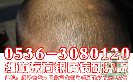 牛皮癣治疗心理疗法不可忽视