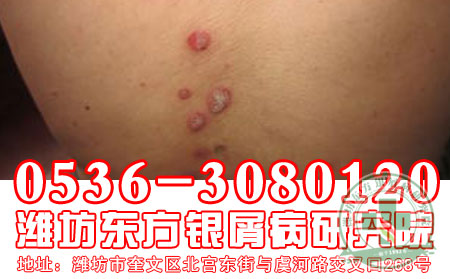 医生教你三小招，轻松远离牛皮癣