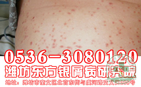 牛皮癣类型及症状