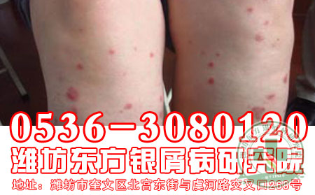 潍坊牛皮癣医生解析儿童牛皮癣诱因