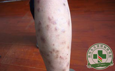 牛皮癣患者请远离垃圾食品