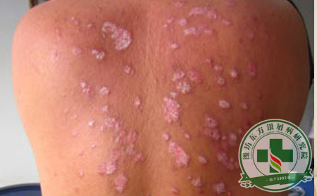 牛皮癣发病中，精神因素有没有比较重要的作用