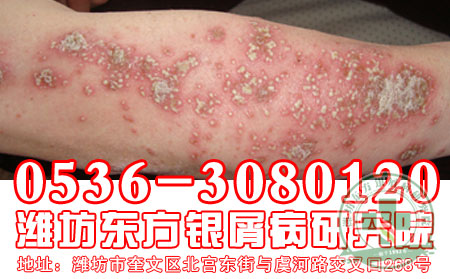 银屑病患者在日常生活中应注意哪几种习惯来预